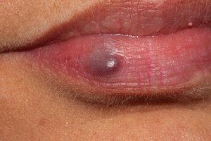 blue spot on lip - Symptoms, Treatments and Resources for ...