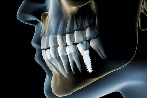 Ceramic Dental Implants at Wellington Family Dentistry, Dr. David Pringle