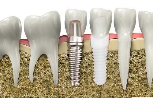 Ceramic Dental Implants at Wellington Family Dentistry, Dr. David Pringle